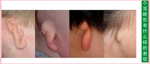 孩子小耳畸形怎么办？小耳畸形有什么样的表现呢？