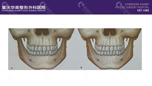 重庆华美整形外科医院下颌角磨骨手术技术优势