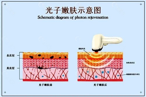 做了十年光子嫩肤会怎么样？皮肤会反弹吗？