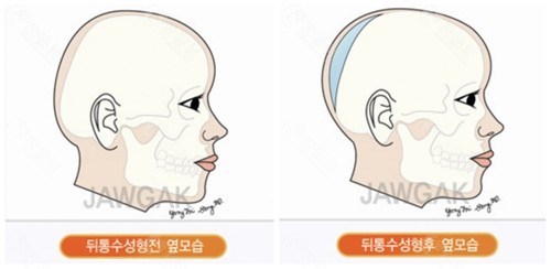 韩国雕刻整形外科医院骨水泥填充实例