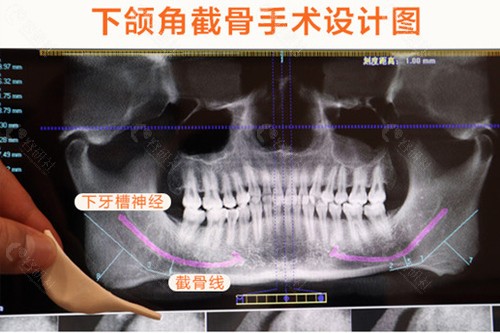 杭州高俊明磨骨多少钱？