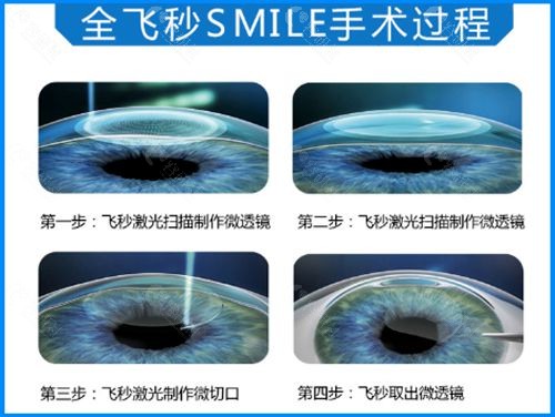 全飞秒激光近视手术过程示意图