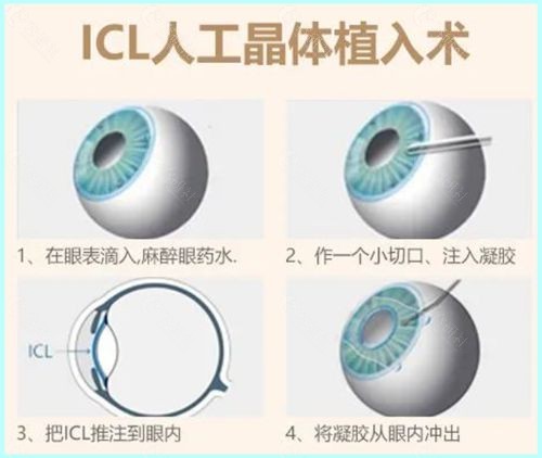 ICL人工晶体植入术的手术原理