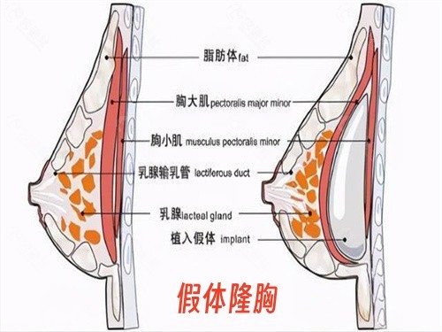 厦门长庚医院隆胸怎么样