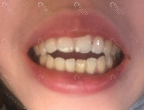 成人牙齿开颌严 重还能矫正过来吗