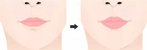 嘴唇太薄改厚的四种手术方式及特点一览