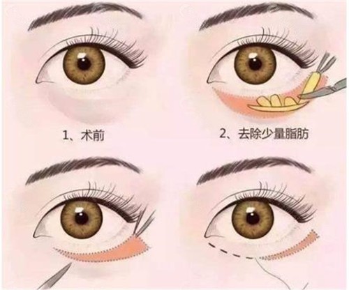 北京八大处靳小雷祛眼袋技术优势