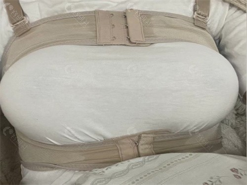 假体隆胸手术后绷带要绑多久 假体隆胸手术后绷带要绑多久