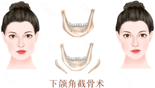 磨颧骨前后对比图明显吗