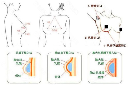 隆胸修复是否可以在初次切口上做手术