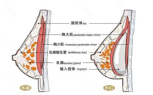 修复隆胸可以马上换假体吗