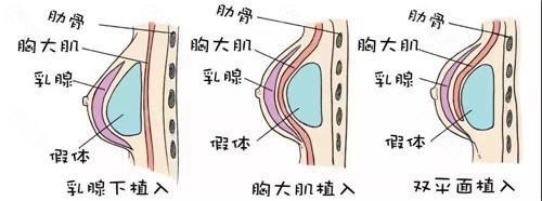 韩国隆胸手术二次修复哪家好