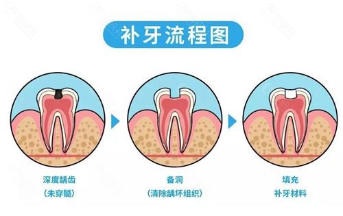 补牙和种植牙哪一种好？