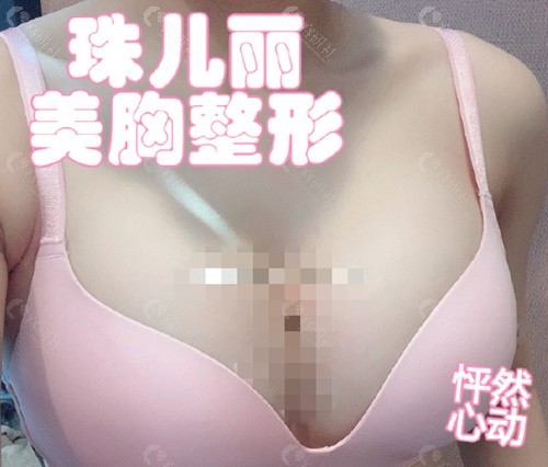 韩国珠儿丽整形外科乳房整形范例