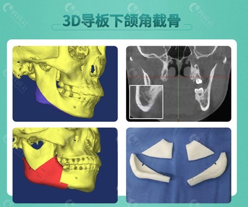 广州广大3d导板下颌角截骨