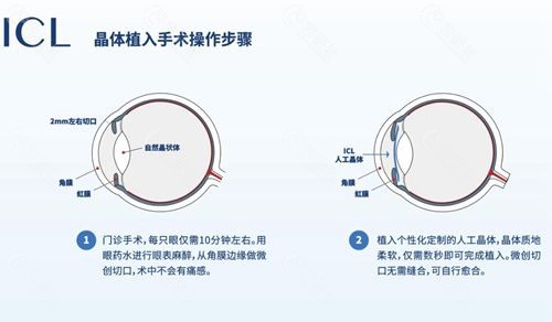 成都地区做晶体植入多少钱
