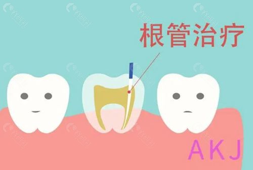 是不是将牙拔了就不用根管治疗了