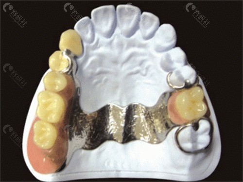 金属假牙的图片