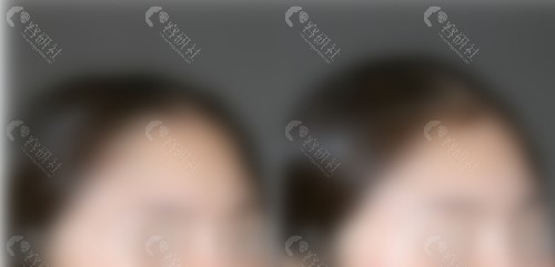 颅顶填充前后对比照