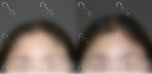 颅顶填充术前术后对比