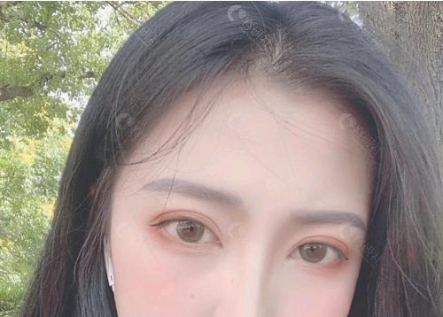 兰州皙妍丽双眼皮实例