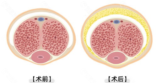 自体脂肪填充增大增粗