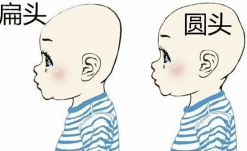 扁头变圆头整形手术