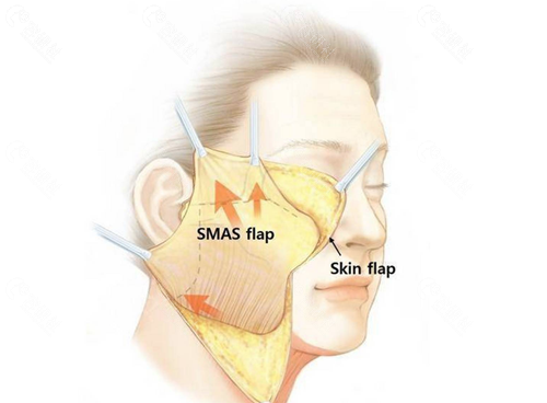 面部SMAS层和皮肤层的解剖结构