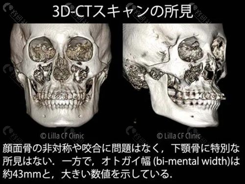 日本Lilla Craniofacial Clinic 形成外科菅原康志术前模拟手术