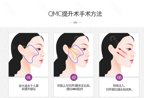 韩国必当归医院面部提升手术方法