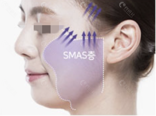 韩国原辰整形外科面部提升方法
