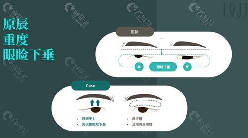 韩国WJ原辰整形外科上睑下垂矫正方法