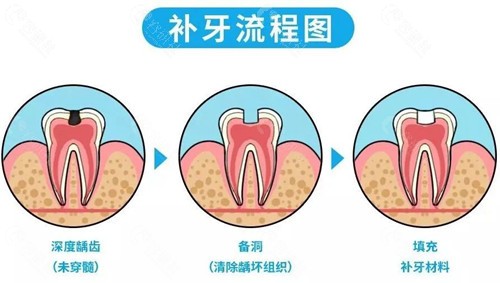 补牙流程