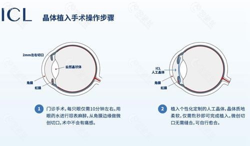 2023晶体植入近视眼手术价格表