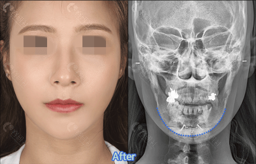 韩国菲斯莱茵整形外科下颌角修复术后