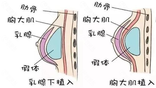 假体隆胸能和真的一样吗