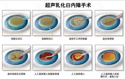 白内障植入的晶体能用多久？