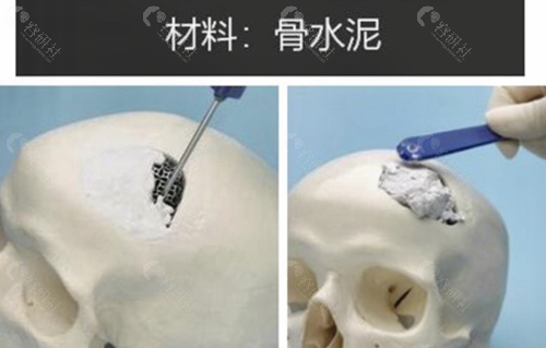 骨水泥材料填充