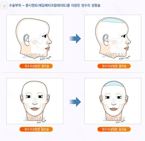雕刻整形外科颅顶增高手术过程