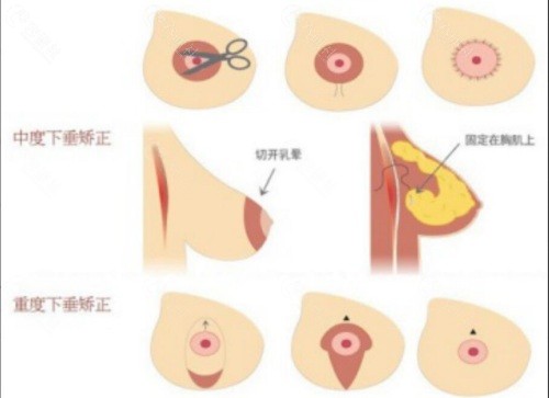 胸下垂矫正手术会不会影响哺乳