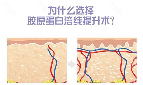 韩国珠儿丽整形外科提升手术优势