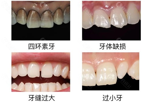 牙贴面美白适用情况