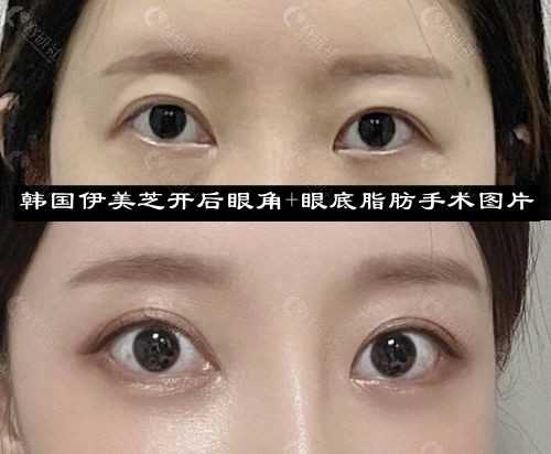 韩国伊美芝开后眼角+眼底脂肪手术前术后对比照