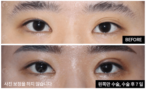 韩国爱护整形医院做多重双眼皮矫正手术怎么样
