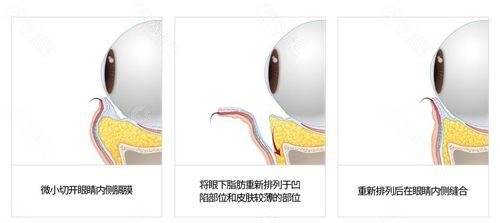 韩国梦想整形外科医院祛眼袋手术