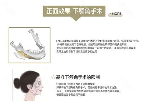 韩国菲斯莱茵整形医院下颌角手术