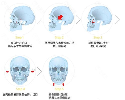 韩国珠儿丽整形外科轮廓手术