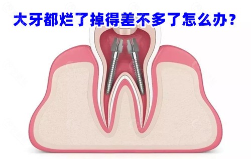 大牙都烂了掉得差不多了怎么办