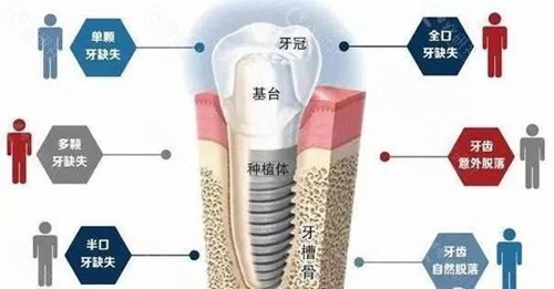 种植牙流程图