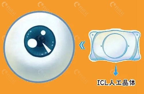 2023人工晶体集采价格表 2023人工晶体集采价格表